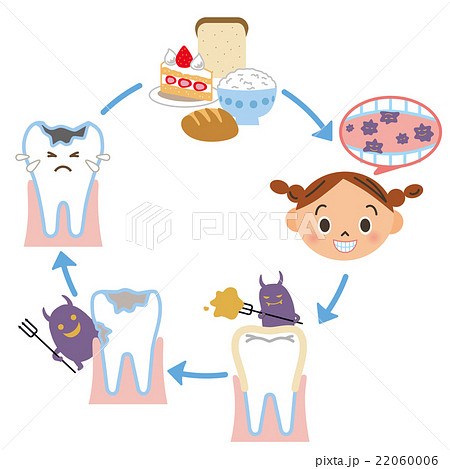 虫歯の説明図のイラスト素材