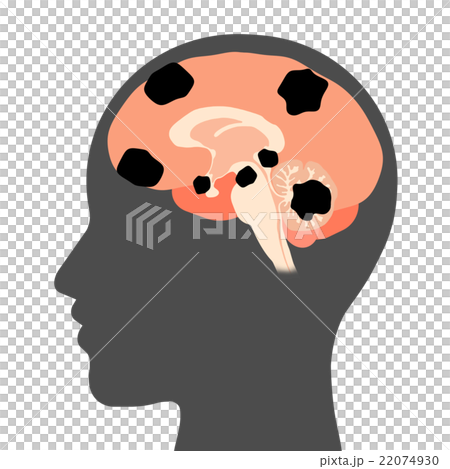 Brain tumor 22074930
