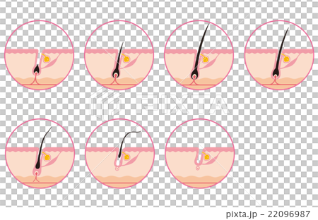 Hair Removal Hair Cycle Hair Cycle 22096987