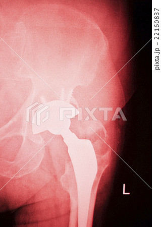 Hip joint surgical implant xray scan Hip joint surgical implant xray scan 22160837