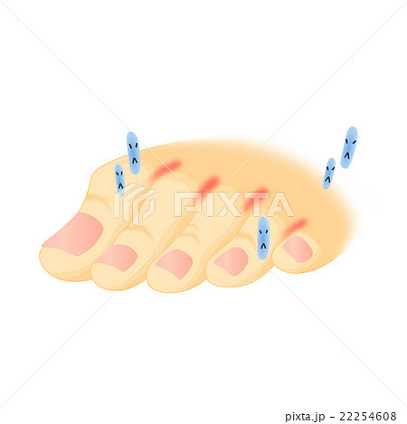 水虫の足と水虫菌のイラスト素材