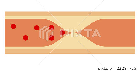 アテローム血栓 アテローム血栓 22284725