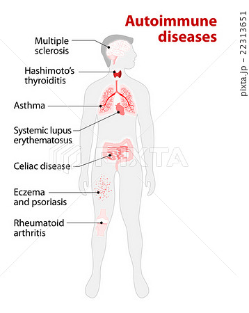 autoimmune attack 22313651