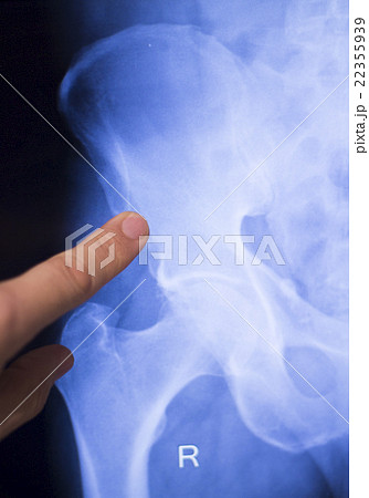 Hip joint surgical implant xray scan 22355939