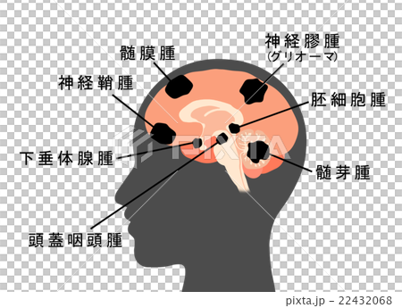 脳腫瘍の図 22432068