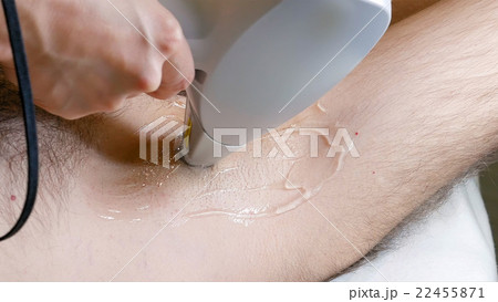 Man gets laser hair removal treatment underarm Man gets laser hair removal treatment underarm 22455871