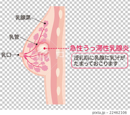胸の断面図 乳腺炎のイラスト素材
