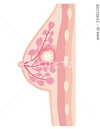 胸の断面図 乳腺炎のイラスト素材