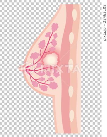 胸の断面図　乳腺炎 22462108