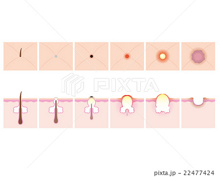 ニキビ略図 22477424