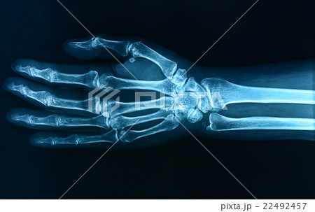 X-ray hand / Many others X-ray images in my portfo 22492457