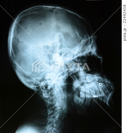 X-ray of head / Many others X-ray images in my por X-ray of head / Many others X-ray images in my por 22492458