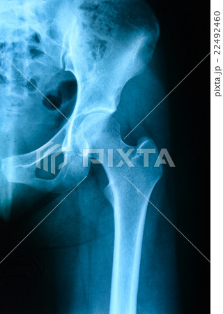 X-ray left hip, is location  22492460