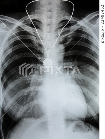 X-Ray Image Of Human Chest  22492462