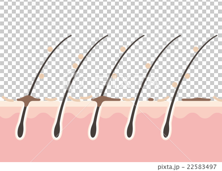 フケのある頭皮 フケのある頭皮 22583497