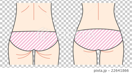 ヒップのビフォーアフター 22641866