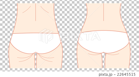 ヒップのビフォーアフター（繊細） 22645515