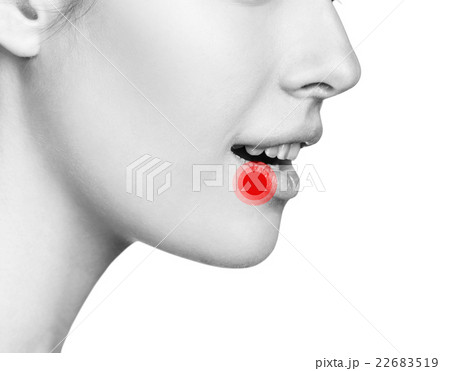Sore on the female lips Sore on the female lips 22683519