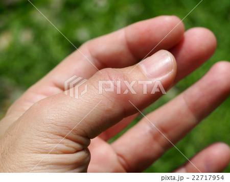 left thumb finger joint pain, gout, rheumatoid 22717954