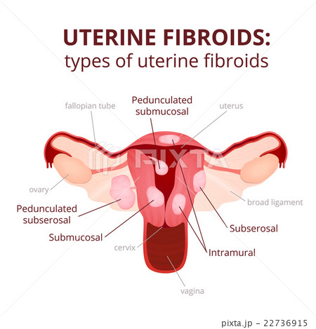 uterine fibroids schematic illustration 22736915