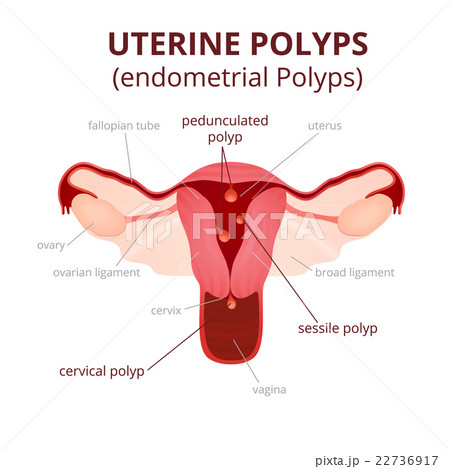 classification of uterine polyps 22736917