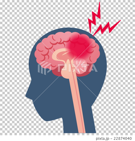 Headache cerebral infarct disease of the brain 22874040