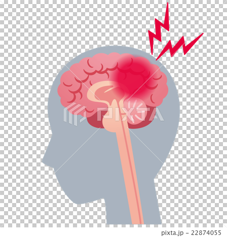 頭痛 脳梗塞 脳の病気 頭痛 脳梗塞 脳の病気 22874055
