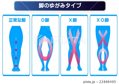 O脚 脚のゆがみの分類 タイプのイラスト素材