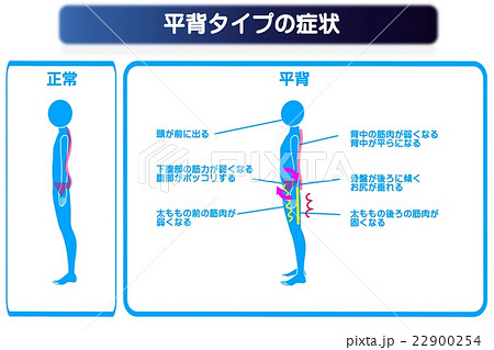 平背タイプのゆがみ症状 22900254