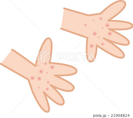 手足口病　手のひら　発疹 22908824