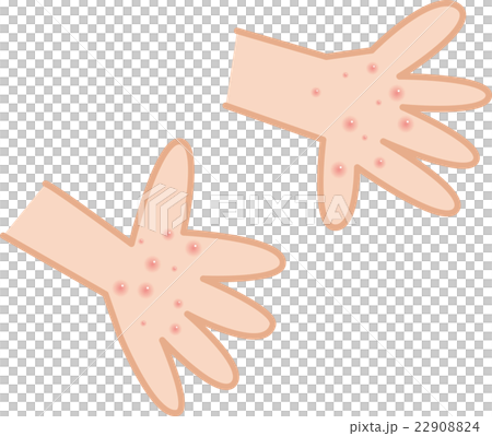 手足口病　手のひら　発疹 22908824