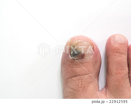 Toe nail with bruise isolate on white background 22912595