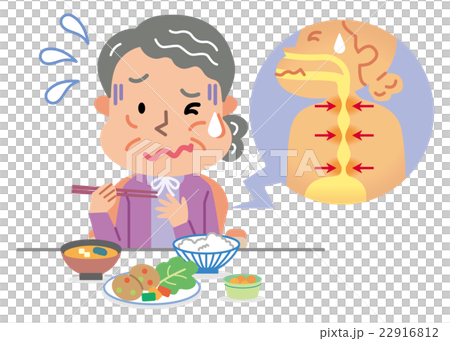 高齢者　女性　食道狭窄　イラスト 22916812