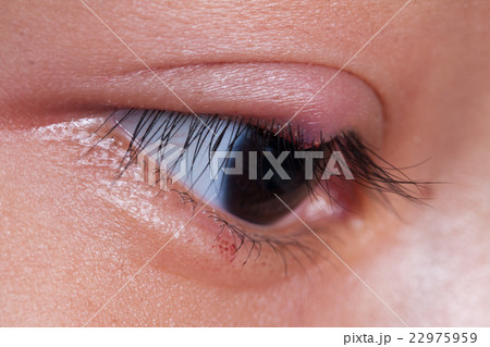 right upper eye lid abscess, stye or hordeolum 22975959