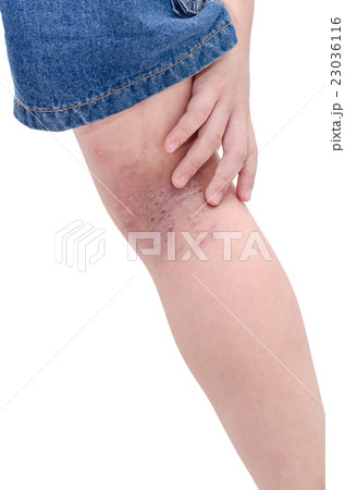 Leg with sore from scratching over white Leg with sore from scratching over white 23036116