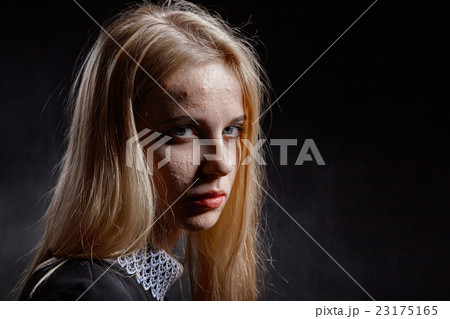 girl with pimply skin 23175165