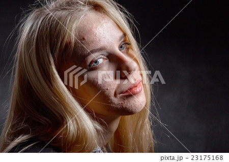 girl with pimply skin 23175168