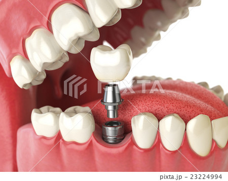 Tooth human implant. Dental concept. Human teeth  23224994