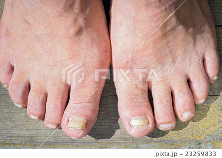 A toenail fungus at the peak of the infection. 23259833