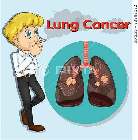 Man smoking and lung cancer 23283132