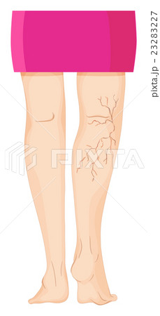 Varicose veins on human legs Varicose veins on human legs 23283227
