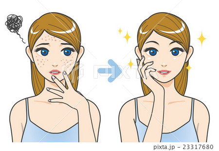女性のニキビケア　ビフォーアフター 23317680