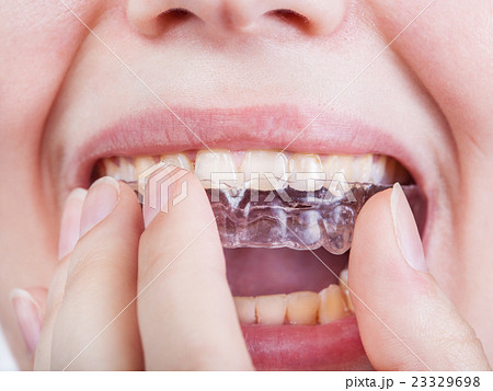 young woman puts clear aligner close up 23329698