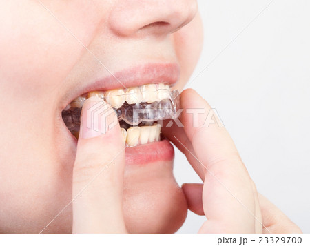 young woman puts transparent aligner 23329700