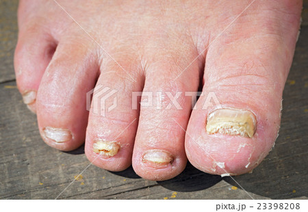 Fungus Infection on Nails of Man's Foot Fungus Infection on Nails of Man's Foot 23398208