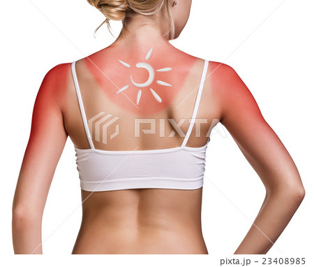 Cream on the shoulder of woman with sunburn 23408985