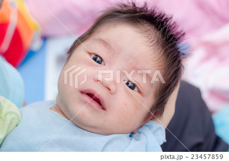 Little asian newborn with many rash on face 23457859