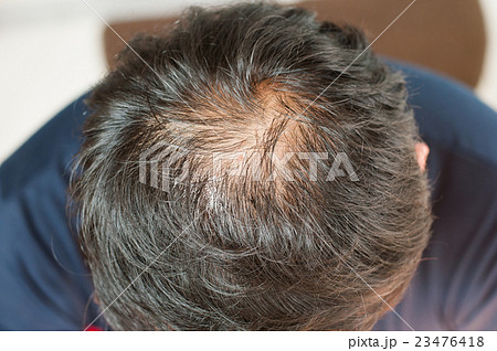 Hair loss, thinning hair and scalp 23476418
