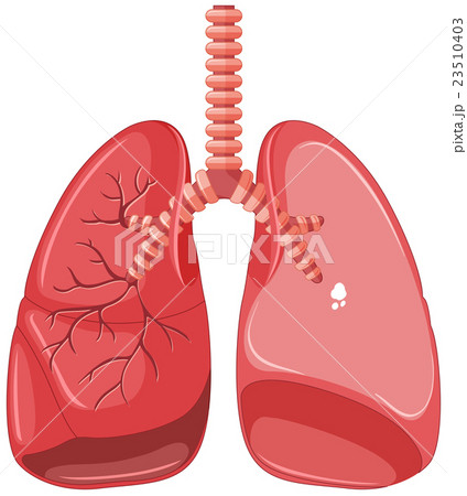 Human lungs with tuberculosis Human lungs with tuberculosis 23510403