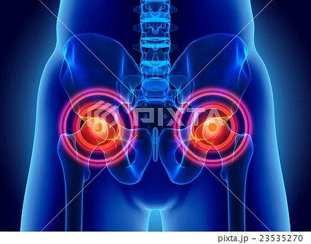 Hip painful skeleton x-ray, 3D illustration. 23535270